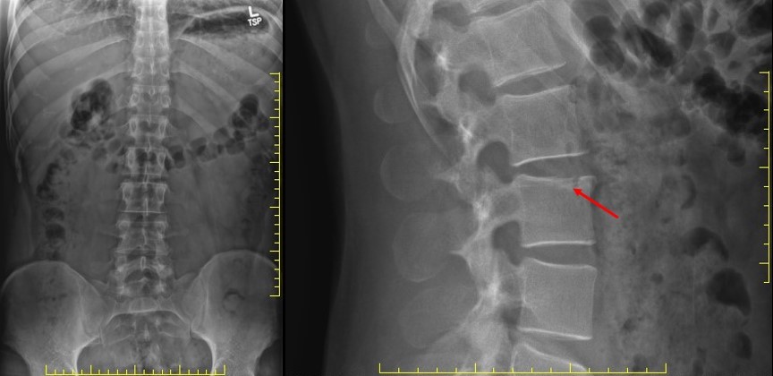 x-ray of lumbar spine