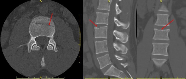 CT images of the lumbar spine