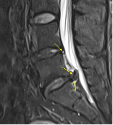 (Image 2) Sagittal T2WI
